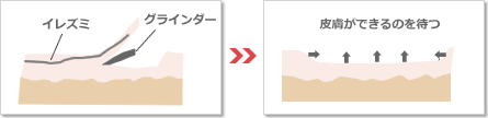 タトゥー切除術について